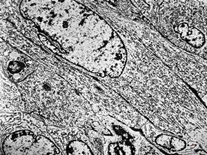 F,61y. | leiomyosarcoma - axilla